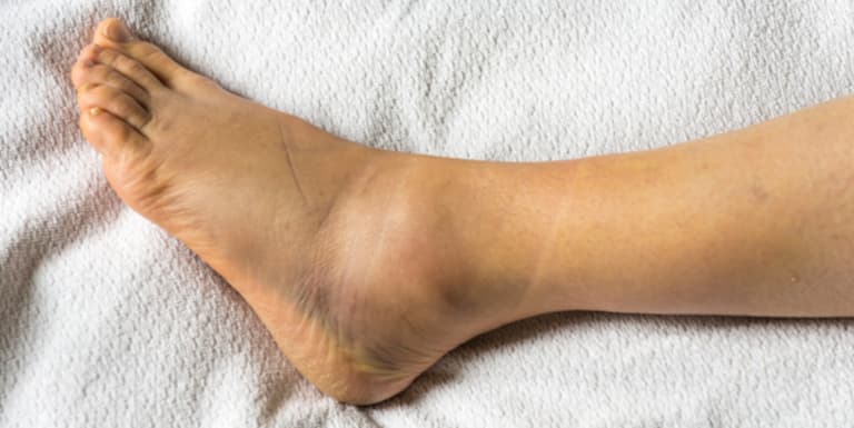 Người bệnh có thể bị sưng tấy ở khu vực cổ chân