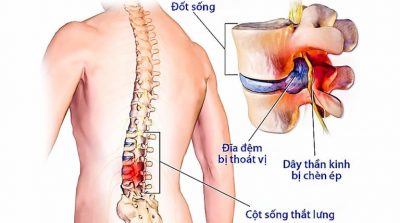 Thoát vị đĩa đệm cột sống thắt lưng: Nguyên nhân và cách điều trị hiệu quả
