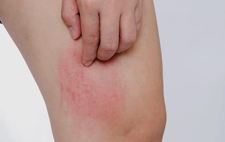 Cào hay gãi da là một trong các nguyên nhân chính dẫn đến căn bệnh này