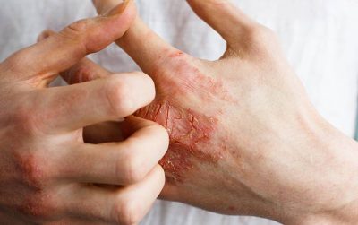 Viêm da tiếp xúc ở tay: Nguyên nhân, dấu hiệu và giải pháp điều trị