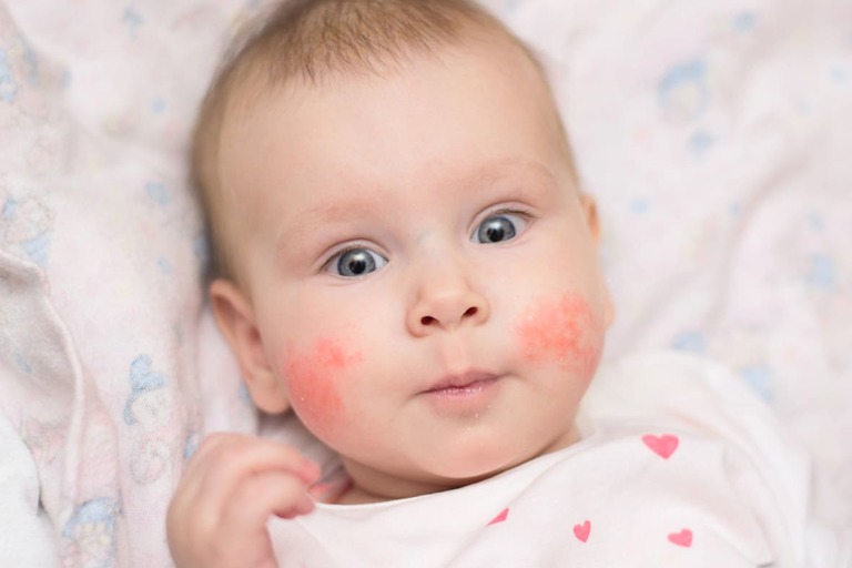 Viêm da tiếp xúc ở trẻ em có 2 loại là kích ứng và dị ứng