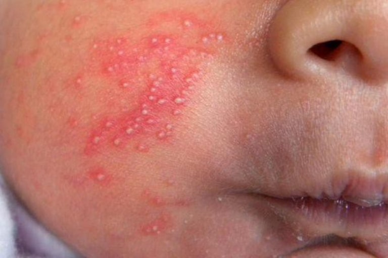 Viêm da tụ cầu ở trẻ gây ra tình trạng nhiều mụn mủ tại các lỗ chân lông, triệu chứng sưng tấy, đau nhức cho trẻ