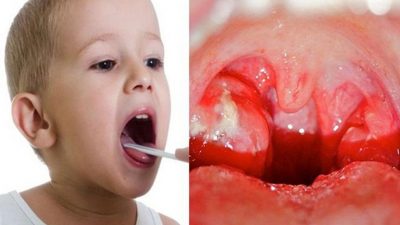 Top 8 cách chữa viêm amidan ở trẻ em không dùng thuốc