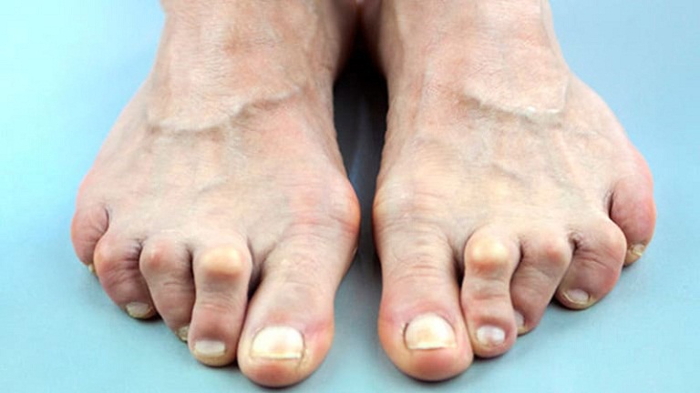  Bệnh viêm khớp bàn chân xuất phát từ các nguyên nhân chủ quan và khách quan