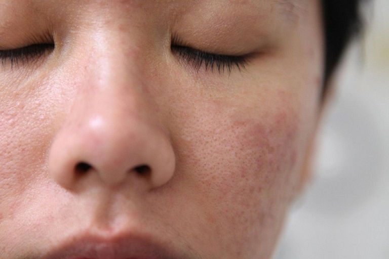 Da mặt bị khô sần và ngứa khiến người bệnh mất tự tin và cực kỳ khó chịu
