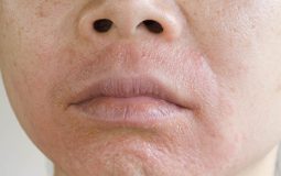 Da mặt bị ngứa và khô là bệnh gì? Nguyên nhân, cách điều trị hiệu quả