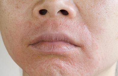 Da mặt bị ngứa và khô là bệnh gì? Nguyên nhân, cách điều trị hiệu quả