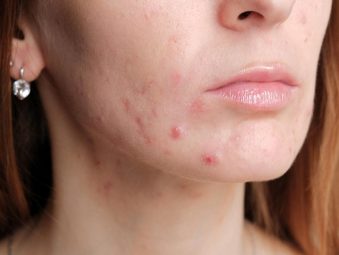 Da mặt bị ngứa và nổi mụn là bệnh gì? [Thông tin chi tiết]