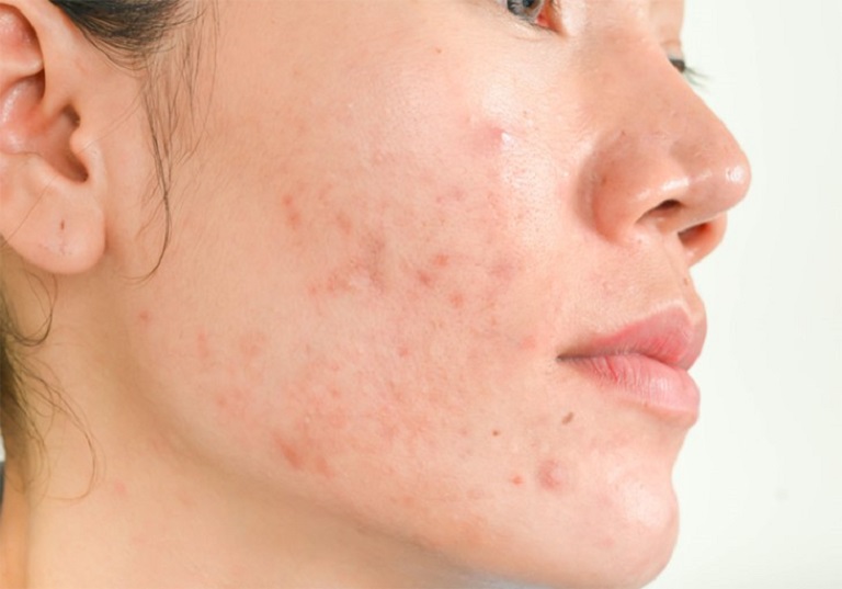 Nội tiết tố thay đổi là một trong những nguyên nhân khiến da mặt bị ngứa và sần sùi