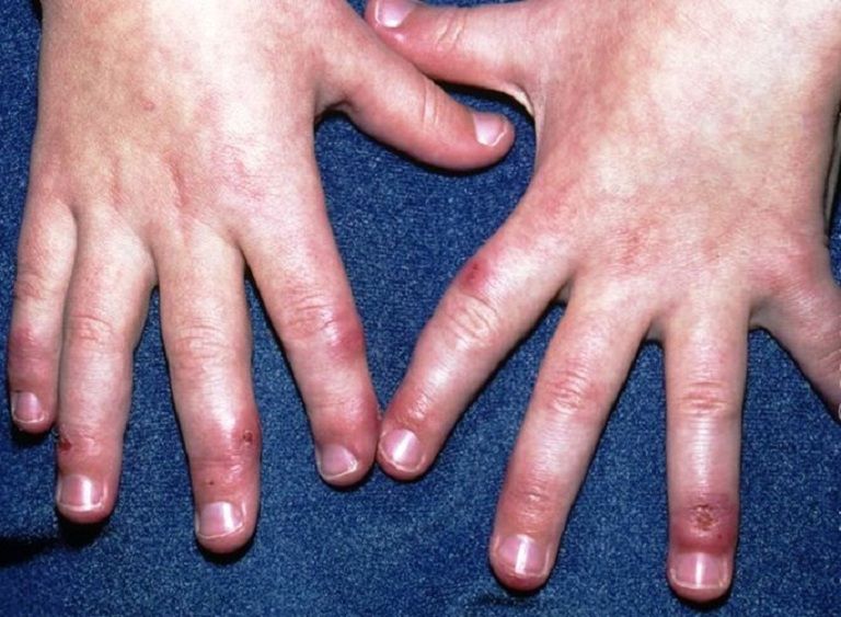 Bệnh cước tay rất phổ biến, nhất là vào mùa đông