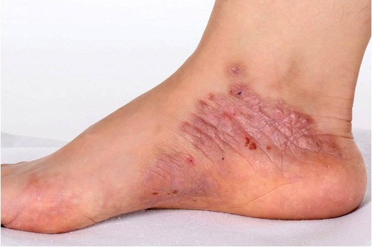 Ngứa gót chân có thể là dấu hiệu của viêm da cơ địa