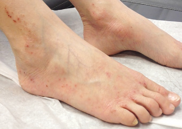 Ngứa mu bàn chân là triệu chứng điển hình của bệnh viêm da cơ địa