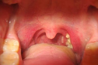 Amidan lưỡi là gì? Dấu hiệu nhận biết bệnh lý và cách điều trị hiệu quả