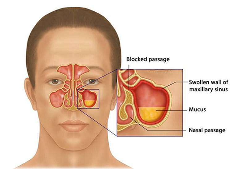 Chi phí mổ viêm xoang mũi có thể phụ thuộc vào tình trạng bệnh