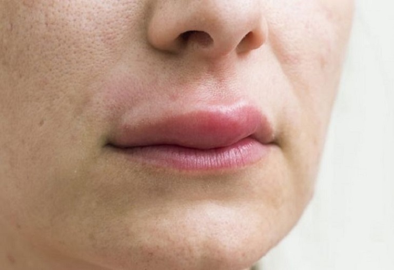 Nổi mề đay sưng môi tuy không quá nguy hiểm nhưng ảnh hưởng tới giao tiếp, ăn uống của người bệnh