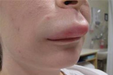 Nổi mề đay sưng môi là bệnh da liễu có thể gặp ở mọi đối tượng