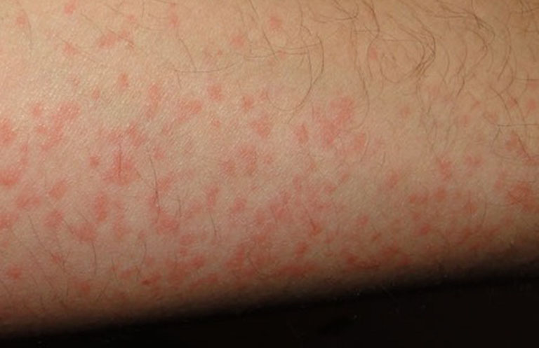 Triệu chứng điển hình của bệnh là các mảng ban có màu đỏ hoặc hồng trên da