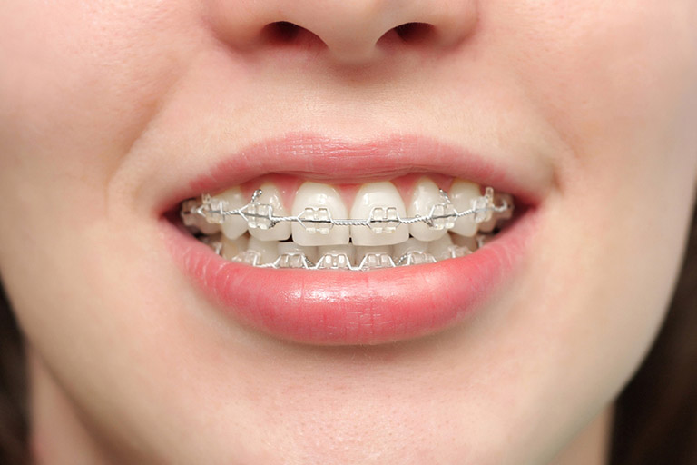 Bảng giá niềng răng mắc cài pha lê sẽ phụ thuộc vào tình trạng răng miệng của bạn