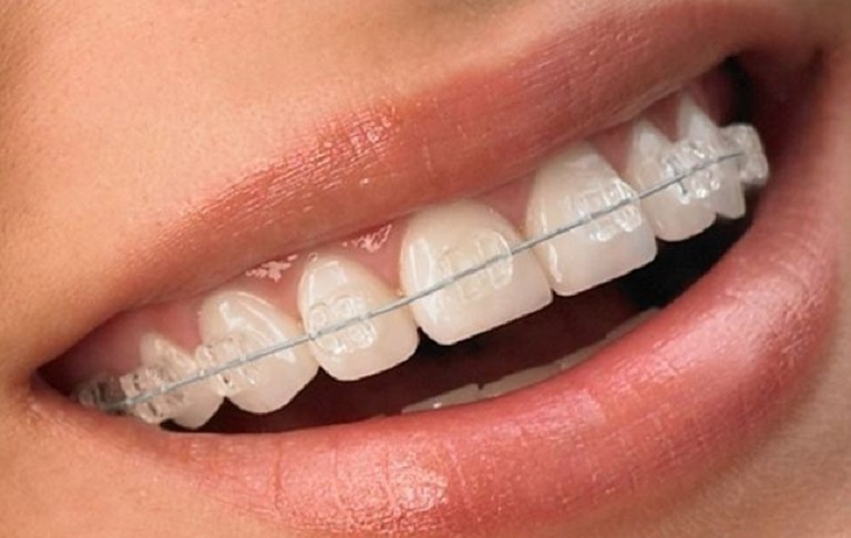 Phương pháp phục hình răng bằng mắc cài pha lê hiện có giá 40 - 45 triệu/2 hàm
