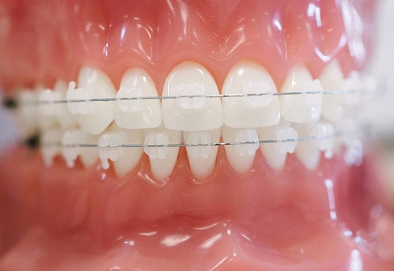 Người bệnh cần đảm bảo sức khỏe răng miệng tốt nhất trước khi tiến hành niềng răng