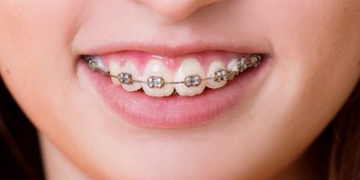 Chi phí niềng răng hô hàm