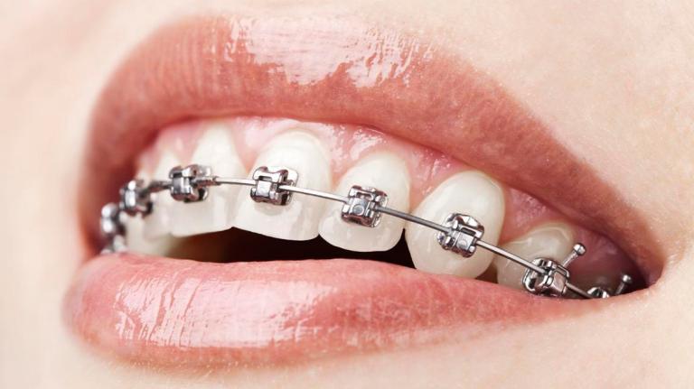 Bạn có thể phục hình răng hô hàm trên bằng mắc cài kim loại tự động