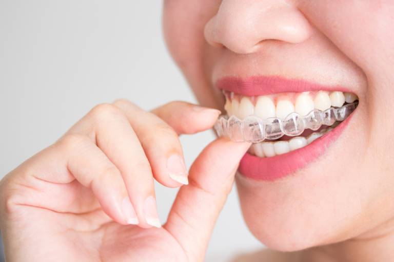 Bạn phải đạt tiêu chuẩn về răng hàm dưới để được niềng răng bị hô hàm trên