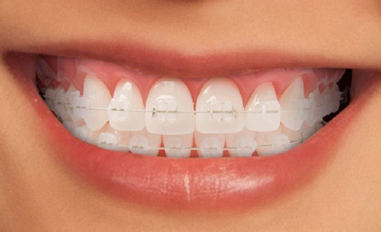 Niềng răng mắc cài sứ dây trong có hai loại chính là mắc cài sứ thường và mắc cài sứ tự buộc