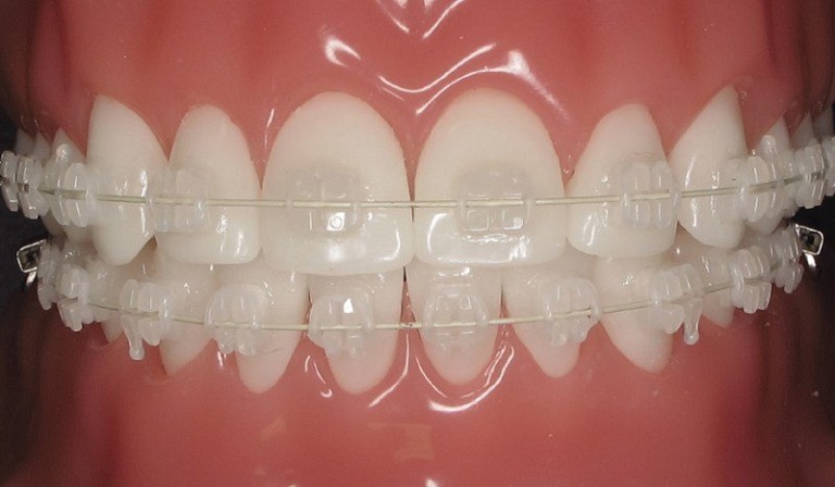 Mắc cài sứ dây trong có thể giúp người bệnh khắc phục khuyết điểm răng hiệu quả
