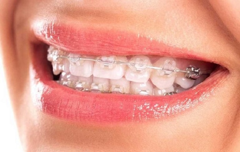 Niềng răng mắc cài sứ tự buộc là kỹ thuật chỉnh nha được cải tiến từ niềng răng mắc cài truyền thống