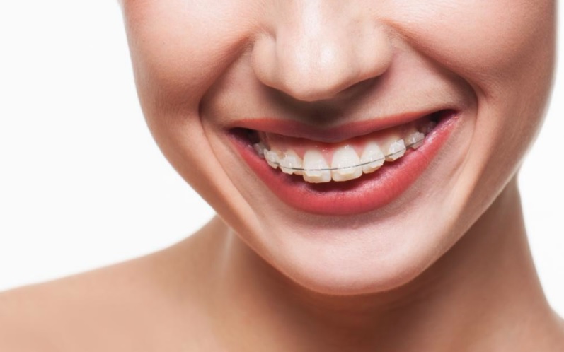 Người bệnh nên vệ sinh răng miệng cẩn thận để đảm bảo kết quả tốt nhất sau khi niềng