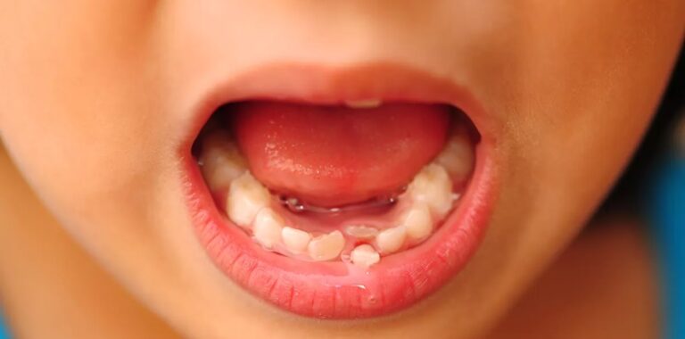 Răng ố vàng do sâu có thể khiến trẻ bị mọc lệch răng vĩnh viễn nếu không được điều trị sớm 