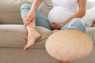 Bà bầu bị nổi mẩn ngứa ở chân là bệnh gì? Cách xử lý an toàn, hiệu quả