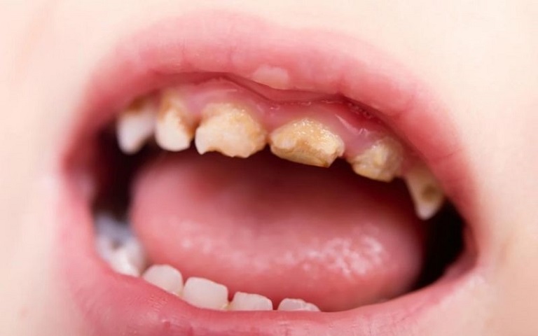 Trẻ từ 1 - 10 tuổi không nên áp dụng các kỹ thuật nha khoa để điều trị răng bị vàng, xỉn màu