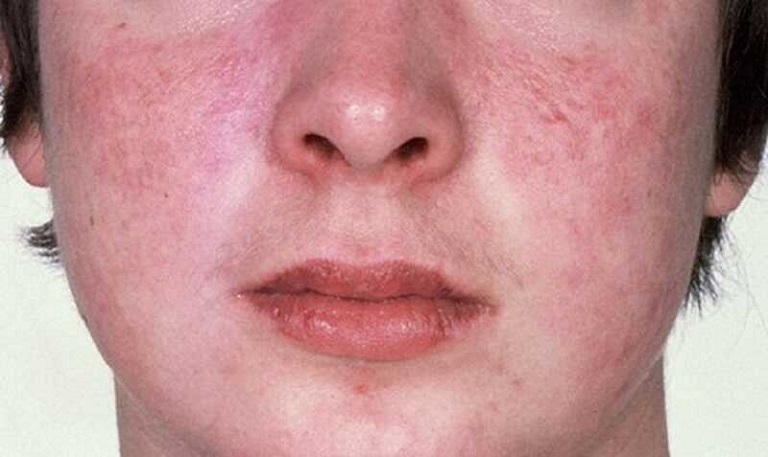 Da mặt khô ngứa mẩn đỏ thường gặp ở nữ giới