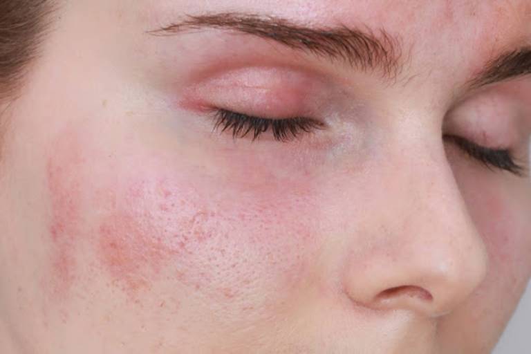 Nổi mẩn đỏ ngứa ở mặt có thể là dấu hiệu của bệnh viêm da dị ứng