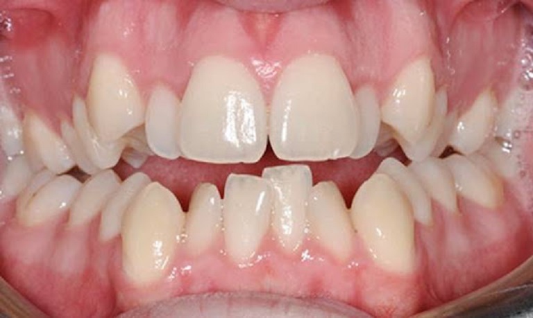 Giá niềng răng khấp khểnh mỗi người sẽ khác nhau tùy thuộc vào nhiều yếu tố