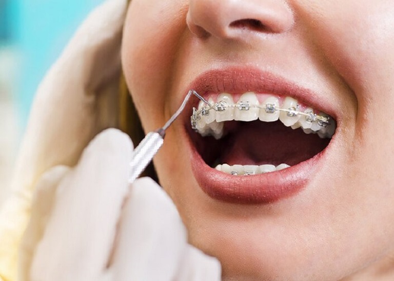 Thông thường thời gian niềng răng khấp khểnh sẽ dao động từ 1 đến 3 năm