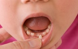 Khi nào nên nhổ răng sữa cho bé?