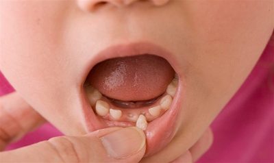 Khi nào nên nhổ răng sữa cho bé?