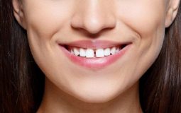 Răng cửa hô là hiện tượng răng cửa bị vượt ra bên ngoài răng cửa phía dưới