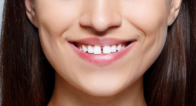 Răng cửa hô là hiện tượng răng cửa bị vượt ra bên ngoài răng cửa phía dưới