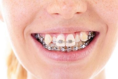 Chuyên gia giải đáp niềng răng có thể giữ lại răng khểnh