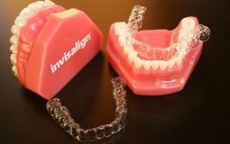 Niềng răng hô bằng nhựa là phương pháp chỉnh nha hiện đại nhất hiện nay
