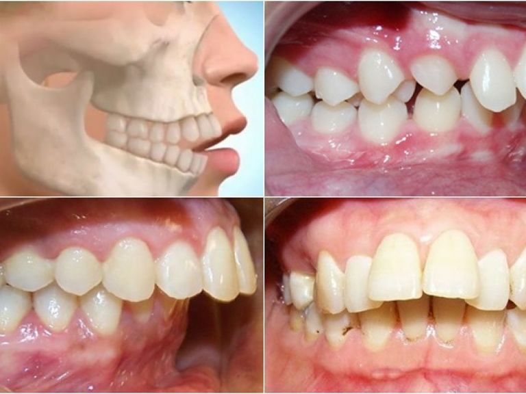 Niềng răng hô hàm là phương pháp chỉnh răng hiệu quả, an toàn