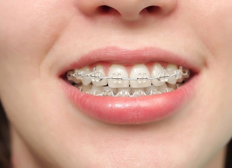 Niềng răng hô hàm giúp cải thiện tính thẩm mỹ và phục hồi chức năng ăn nhai
