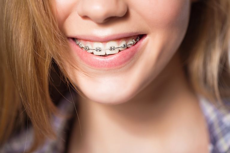 Niềng răng mắc cài kim loại là kỹ thuật niềng răng phổ biến được nhiều người lựa chọn
