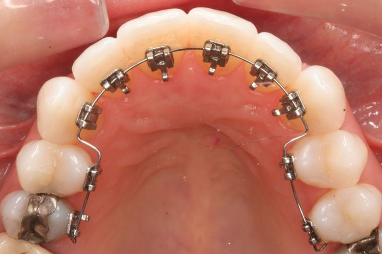 Niềng răng mắc cài trong là kỹ thuật niềng răng hô hàm hiệu quả, an toàn