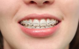 Niềng răng hô không cần nhổ răng là phương pháp sử dụng các khí cụ để đưa răng về đúng vị trí