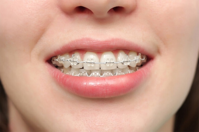 Niềng răng hô không cần nhổ răng là phương pháp sử dụng các khí cụ để đưa răng về đúng vị trí
